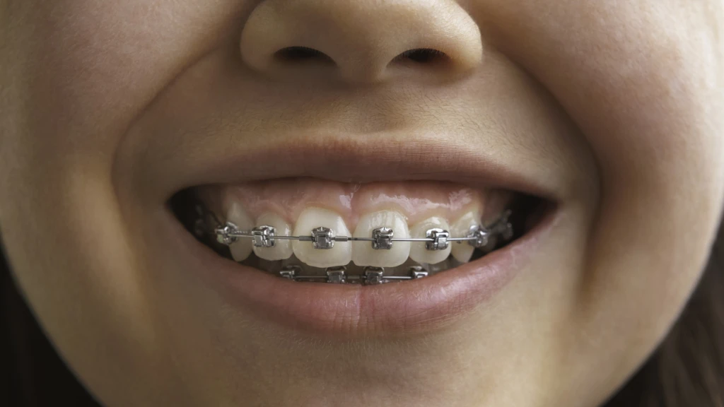 Orthodontie adolescent &agrave; Verviers