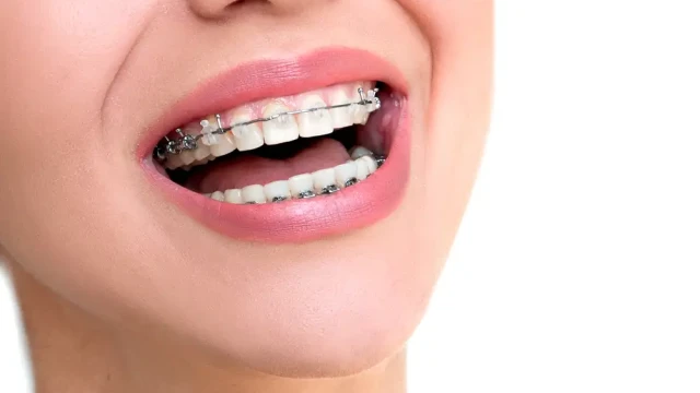 Orthodontie pour adolescent