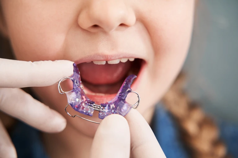 appareil orthodontique amovible pour enfants